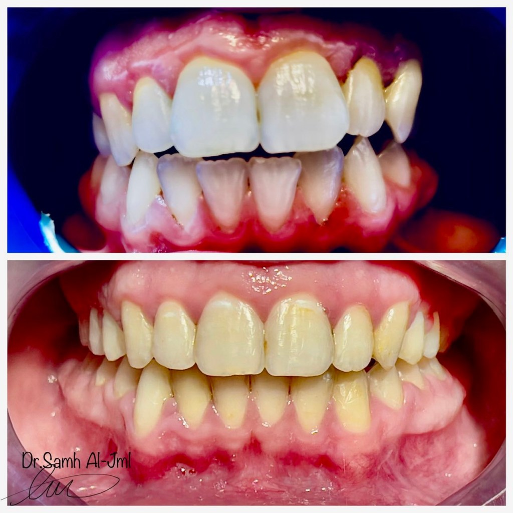 College before & after comparison #Orthodontic treatment
